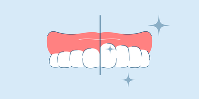 gingivectomy