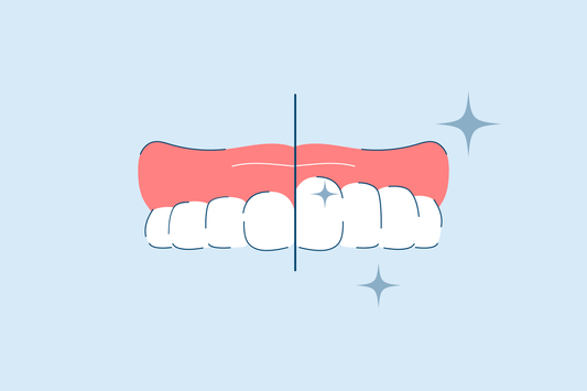 gingivectomy