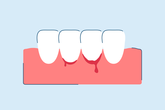 Bleeding Gums: Causes, Prevention, and Treatments