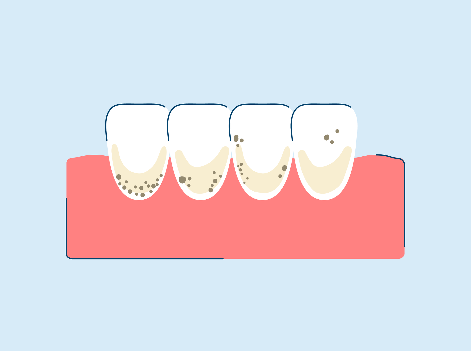 Brown Stains on Teeth: Prevention, Causes, and Treatment