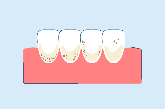 Brown Stains on Teeth: Prevention, Causes, and Treatment