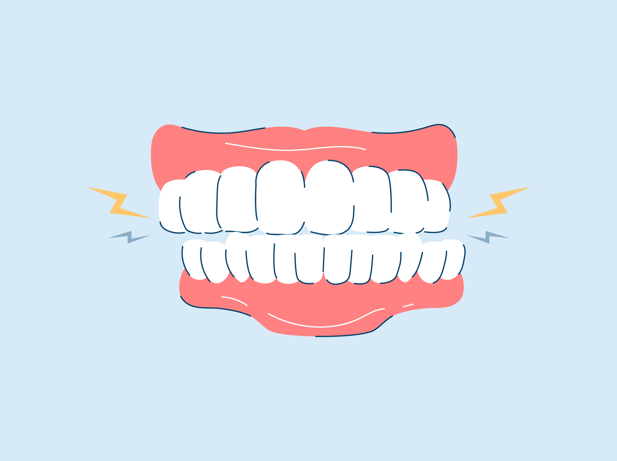 Bruxism (Teeth Grinding): Symptoms, Causes, and Treatments