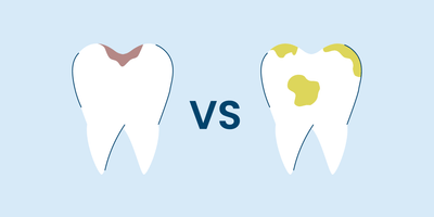 Cavity vs. Stain: How to Tell the Difference