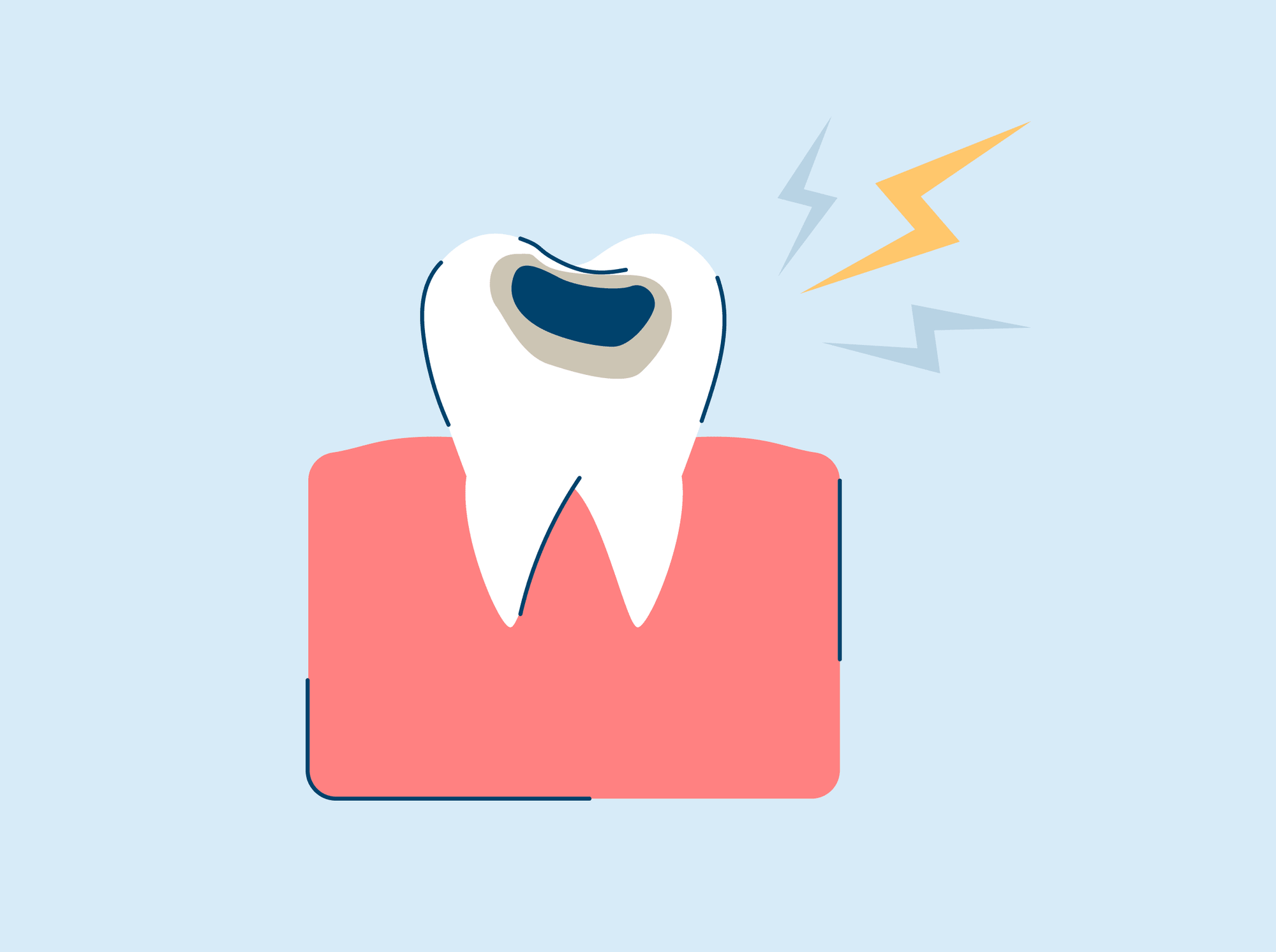 an illustration of a tooth with a cavity