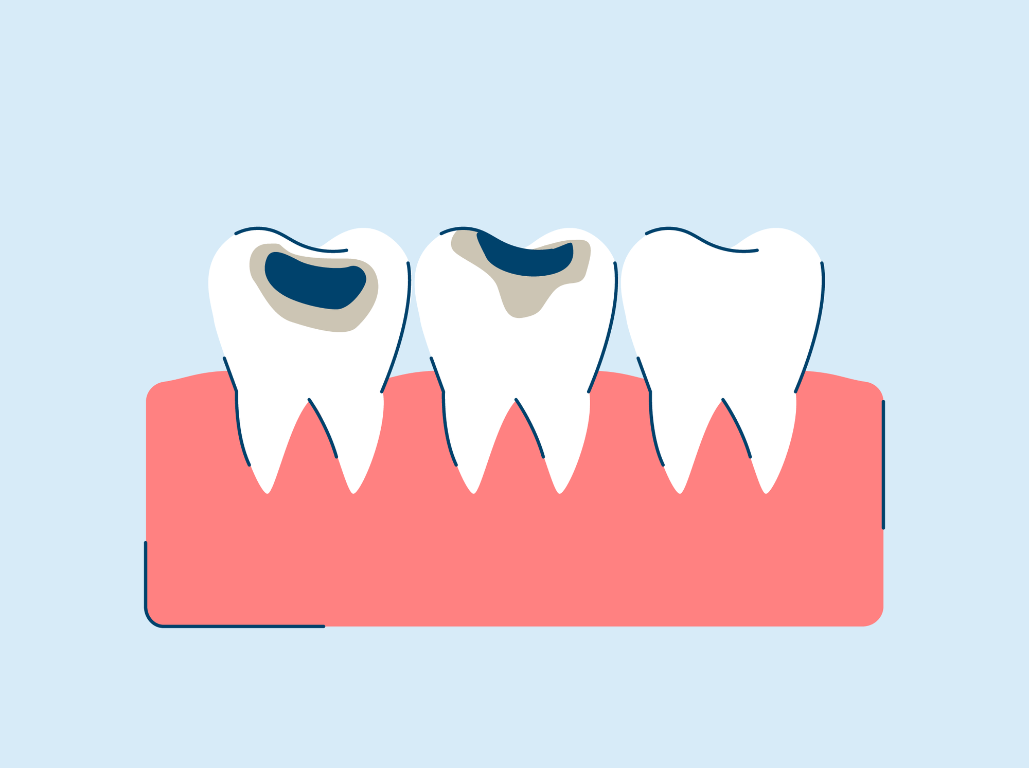 Cavity and Tooth Decay: Symptoms and Causes