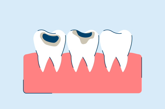 Cavity and Tooth Decay: Symptoms and Causes