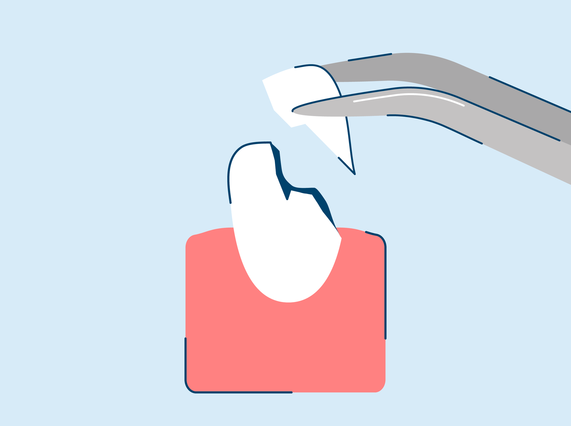 Chipped Tooth Causes and Repair