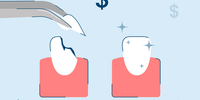 How Much Does It Cost to Fix a Chipped Tooth?