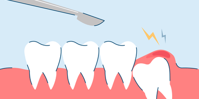 How Much Does Wisdom Teeth Removal Cost?