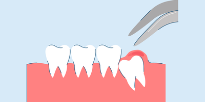 emergency wisdom tooth removal process - everything you need to know