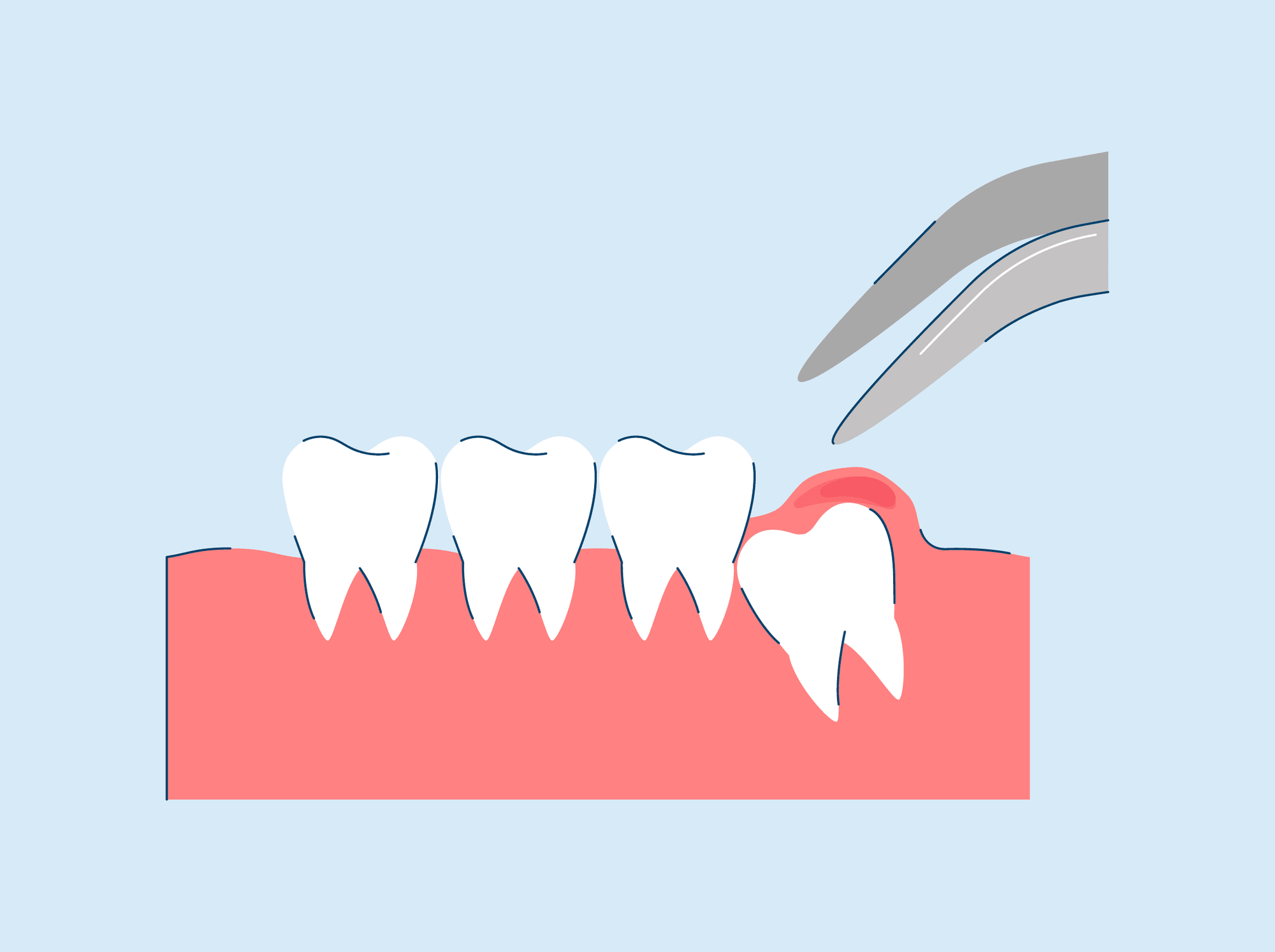 emergency wisdom tooth removal process - everything you need to know