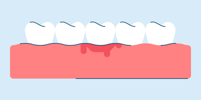 Gingivitis: Causes, Symptoms, and Treatment
