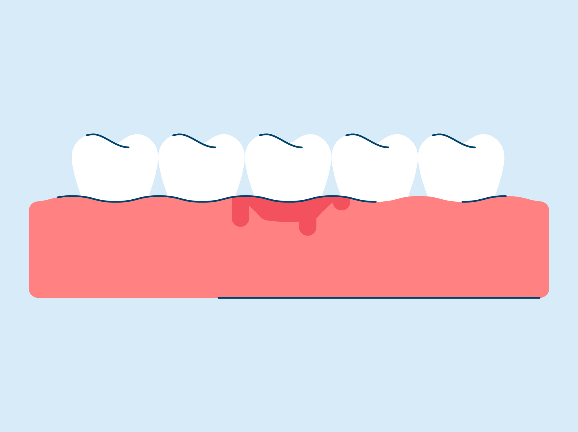 Gingivitis: Causes, Symptoms, and Treatment