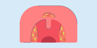 early stage white spots throat cancer