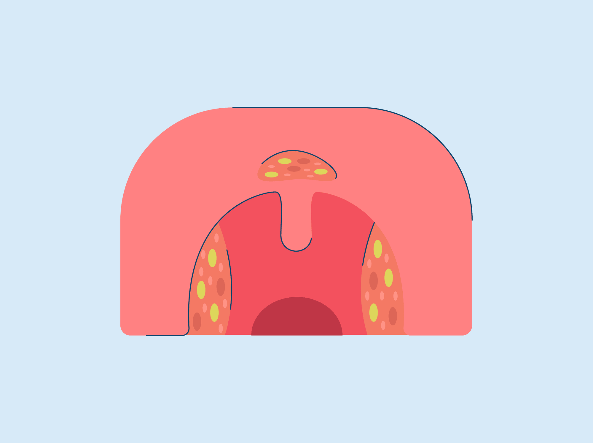 early stage white spots throat cancer