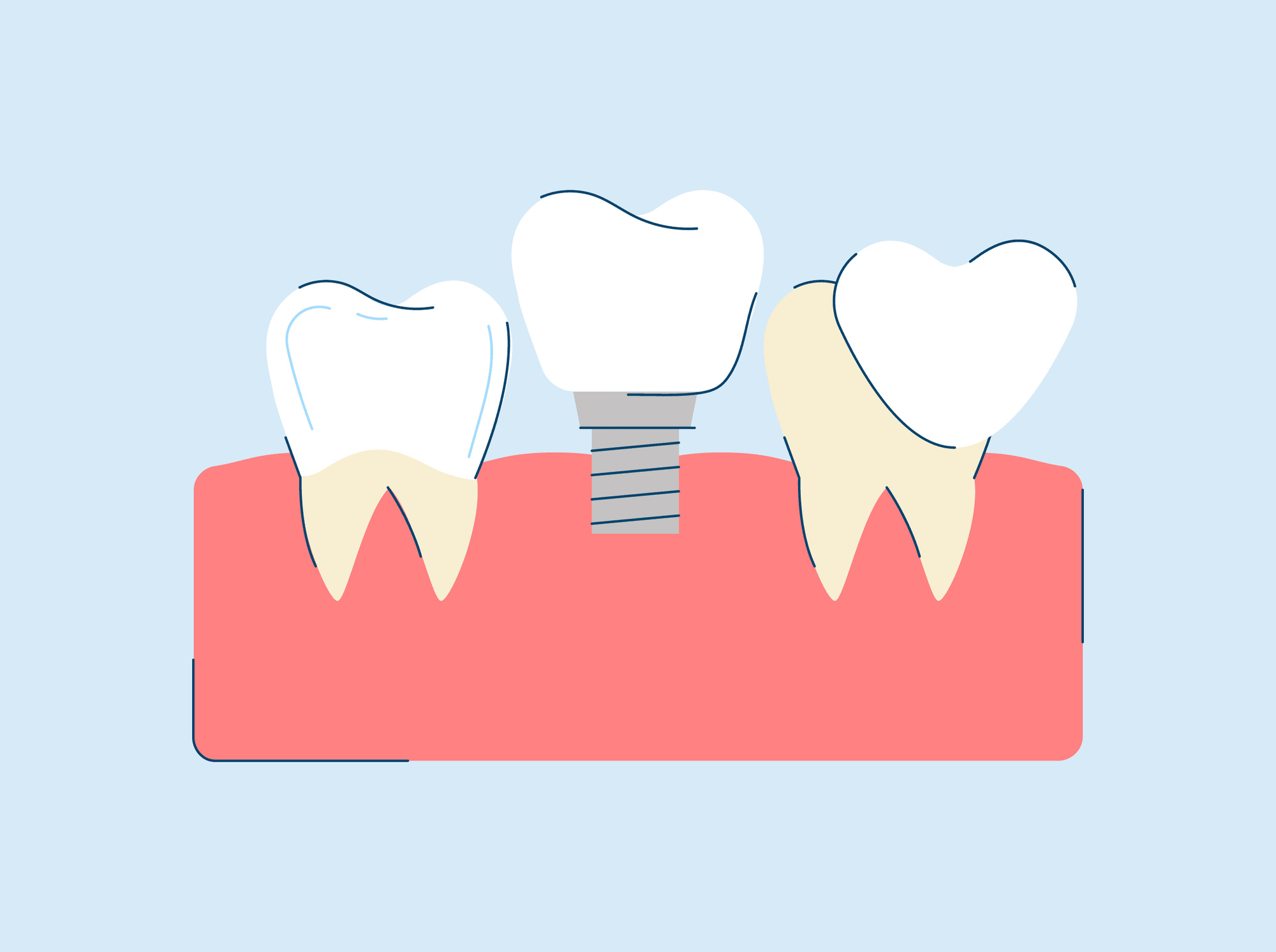Restorative Dentistry: Procedures and Treatments