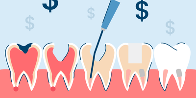 How Much Does a Root Canal Cost?