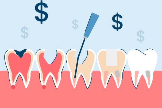 How Much Does a Root Canal Cost?