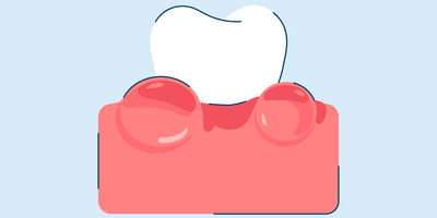 How to Treat Sore Gums