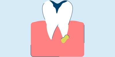 Tooth Abscess: Stages, Symptoms, and Treatment