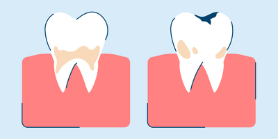 Tooth Decay: Causes, Symptoms, and Treatment
