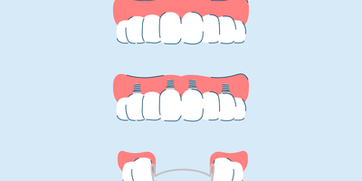 Types of Dentures and Cost: Everything You Need to Know