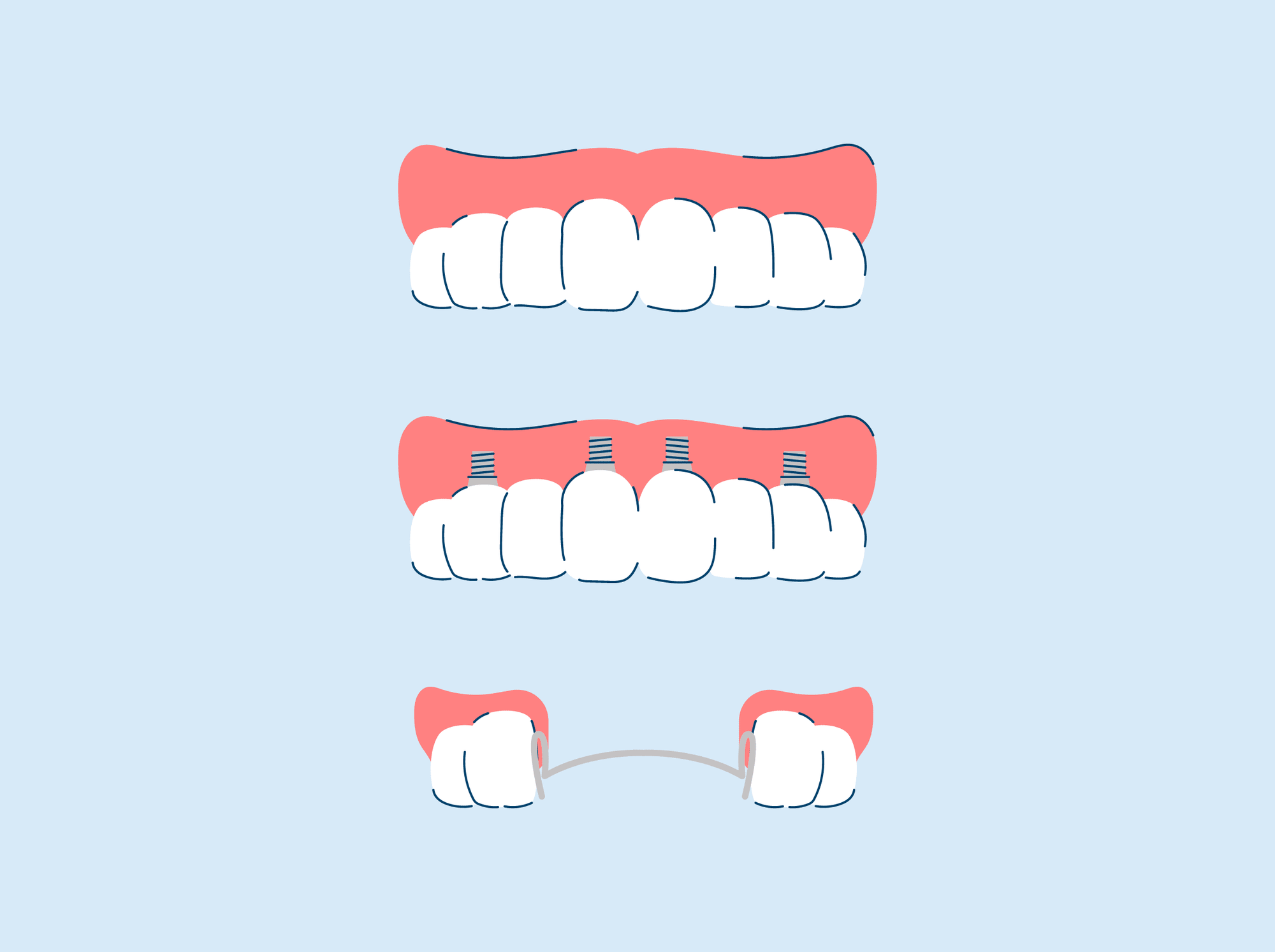 Types of Dentures and Cost: Everything You Need to Know
