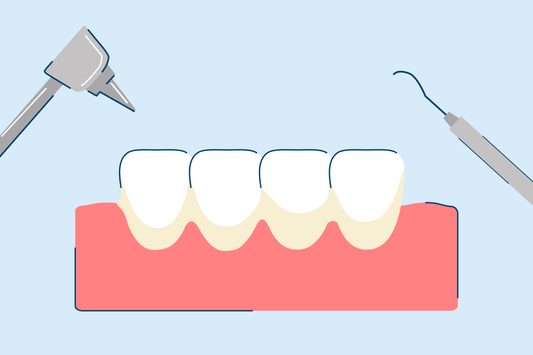 What Causes Tartar on Teeth?