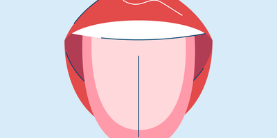What Causes a White Tongue?