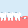 Wisdom Teeth Symptoms (When They're Growing In)