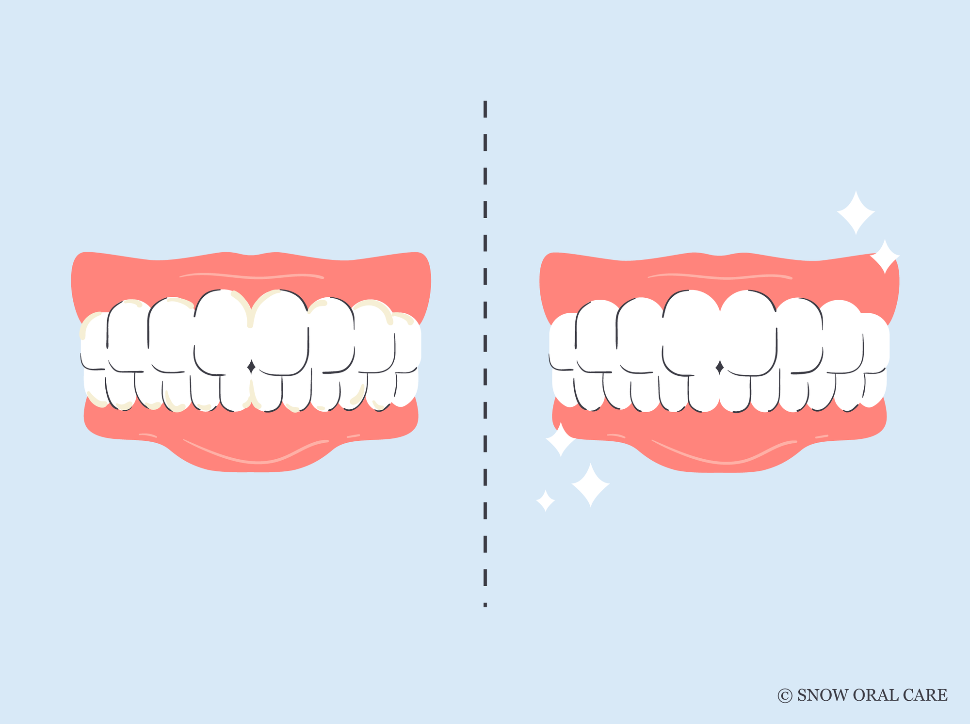 before and after water flosser