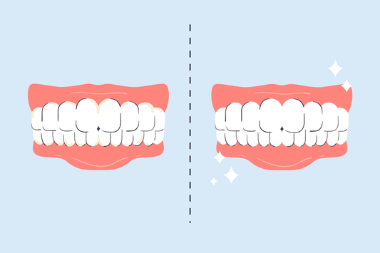 before and after water flosser