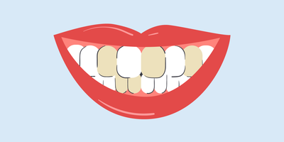 brown teeth causes 