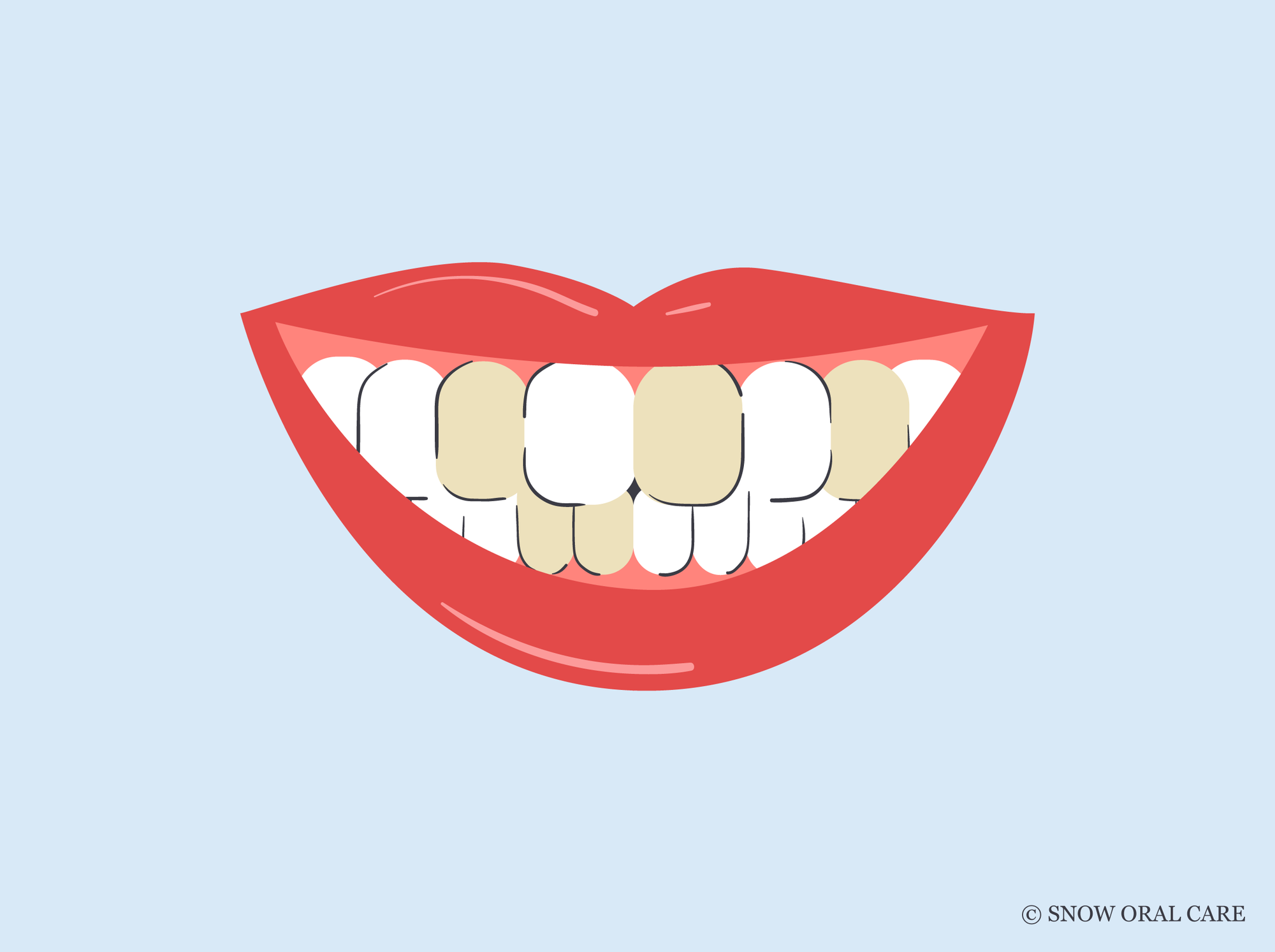 brown teeth causes 