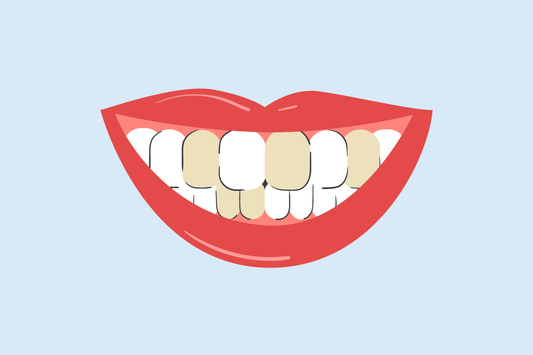 brown teeth causes 