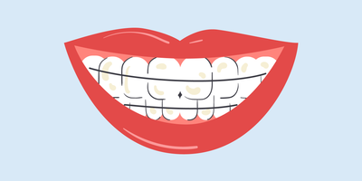 can a retainer stain your teeth