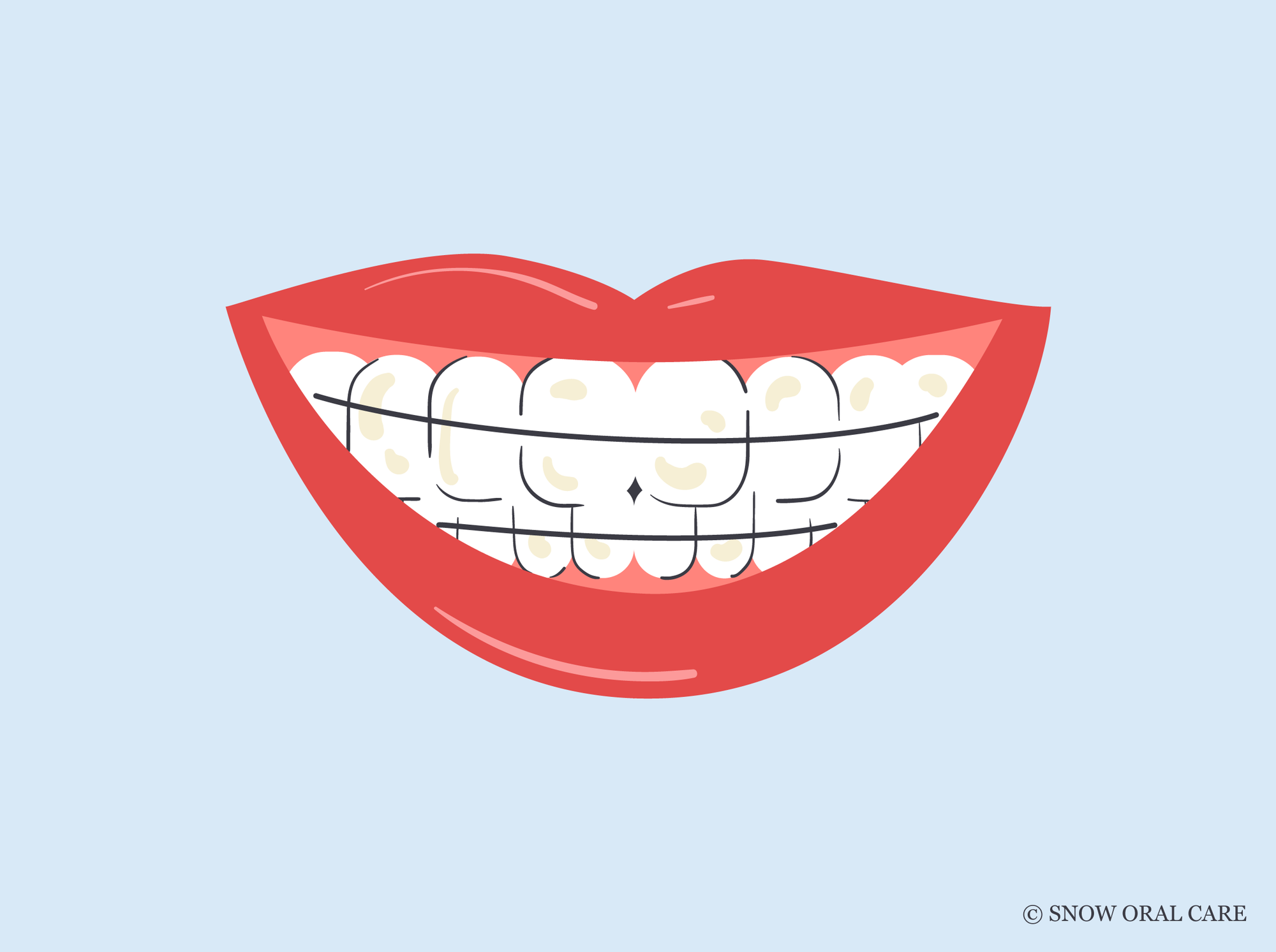 can a retainer stain your teeth