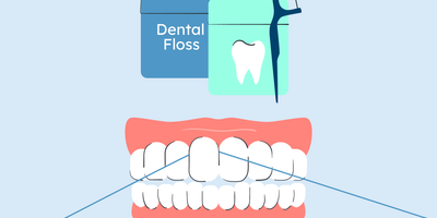 can i floss after deep cleaning