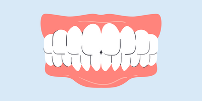 can teeth whitening cause receding gums 