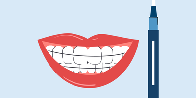 can you put teeth whitening gel in your retainer