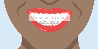 can you use teeth whitening strips with braces 