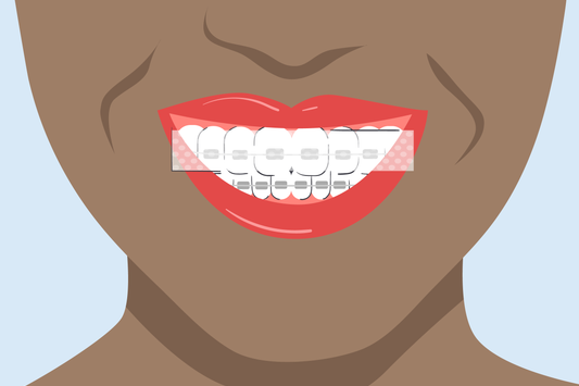 can you use teeth whitening strips with braces 
