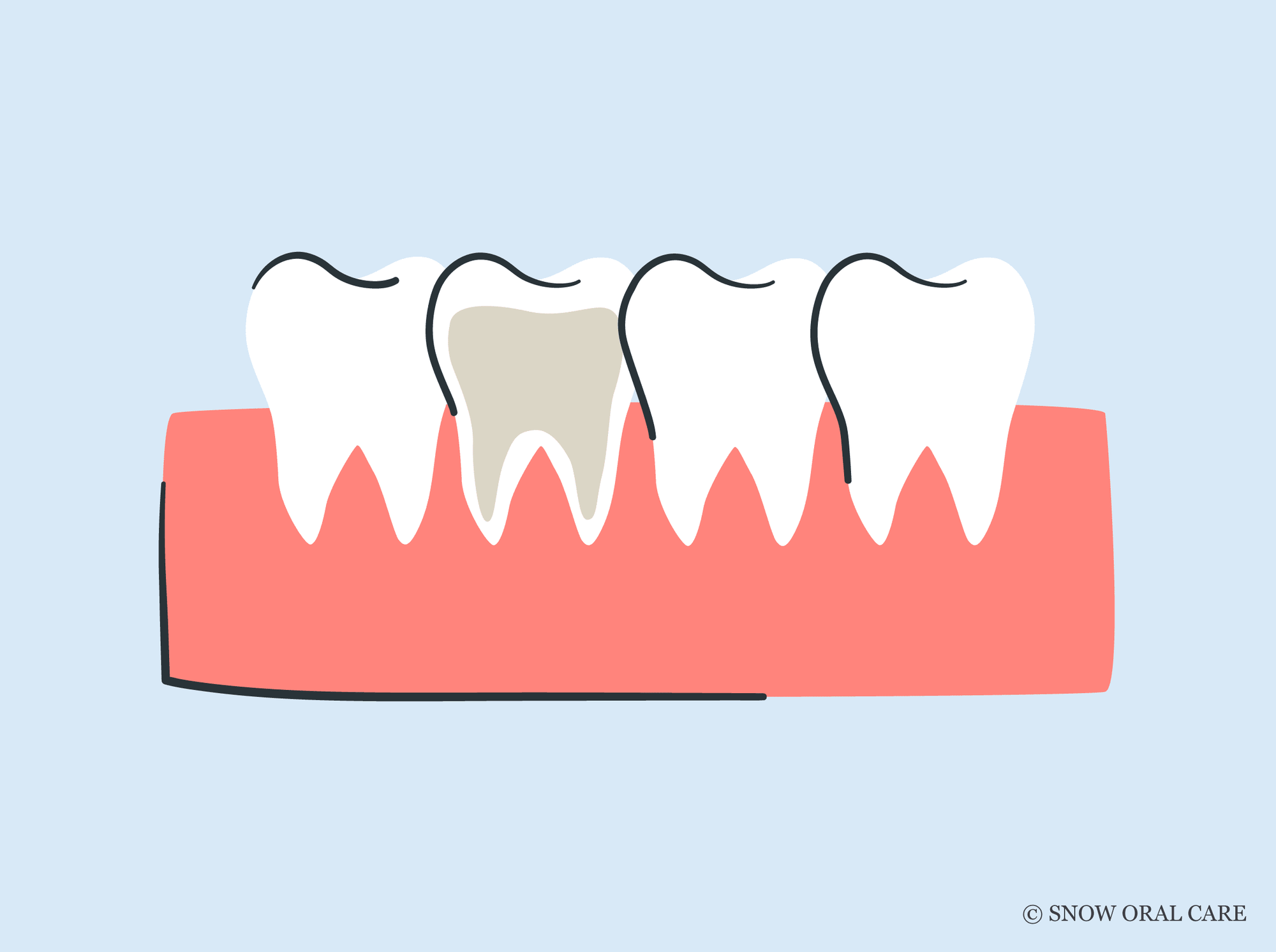 can you whiten a root canal tooth 