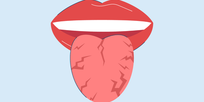 cracks in tongue