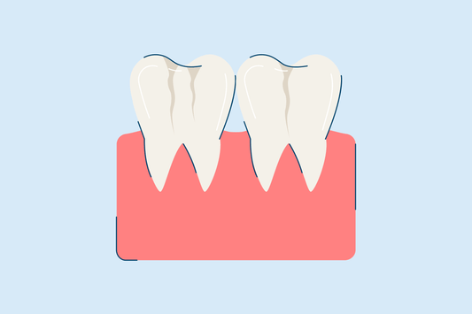 craze lines teeth causes and treatment