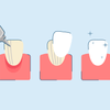 Dental Veneers Process: A Step-by-Step Guide