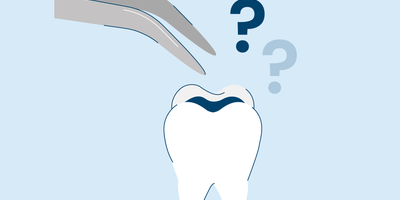 How Long Do Fillings Last?