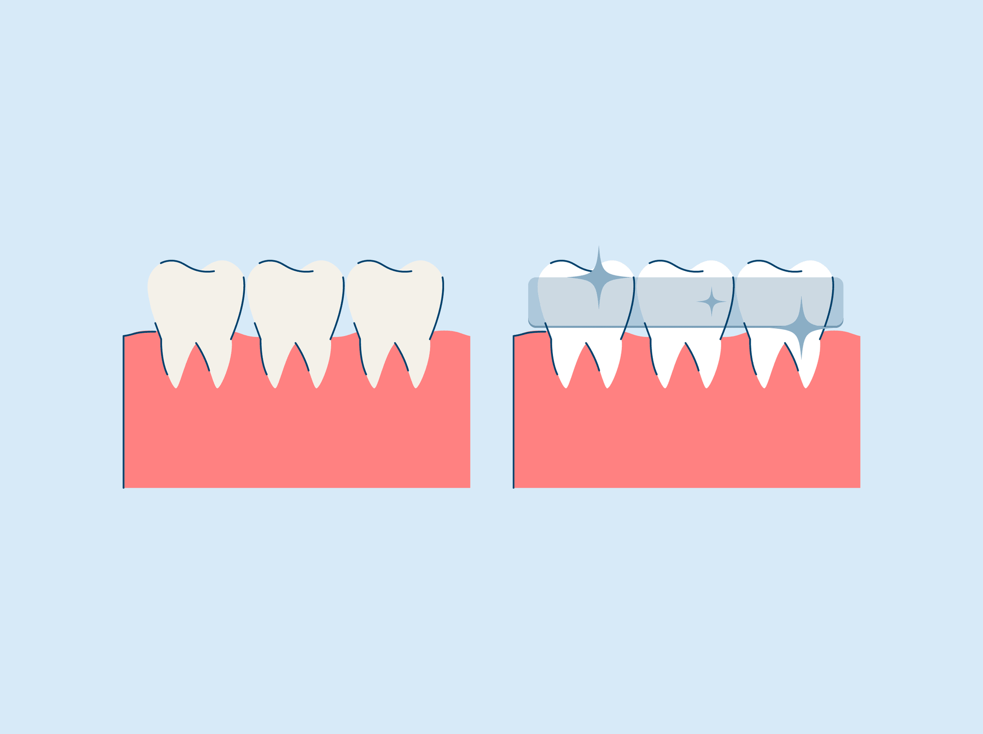 how long do teeth whitening strips take to work