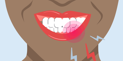 how long do zingers last after teeth whitening 