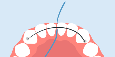 how to floss under permanent retainer without threader